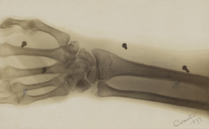 Lot 4122, Auction  127, X-Ray Photography, X-ray of a forearm and hand